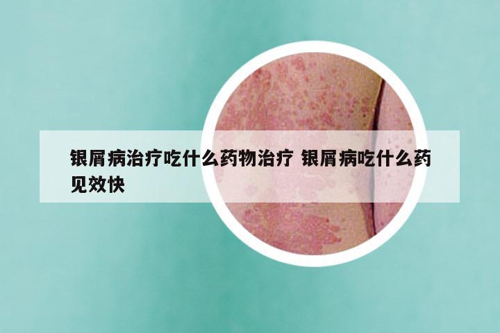银屑病治疗吃什么药物治疗 银屑病吃什么药见效快