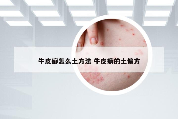 牛皮癣怎么土方法 牛皮癣的土偏方