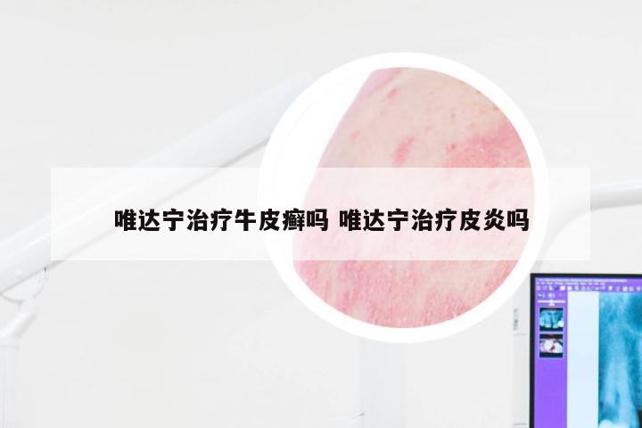 唯达宁治疗牛皮癣吗 唯达宁治疗皮炎吗
