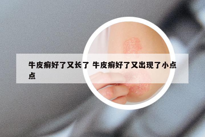 牛皮癣好了又长了 牛皮癣好了又出现了小点点
