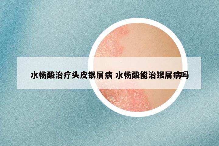 水杨酸治疗头皮银屑病 水杨酸能治银屑病吗