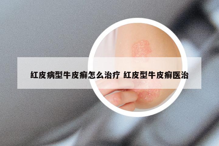红皮病型牛皮癣怎么治疗 红皮型牛皮癣医治