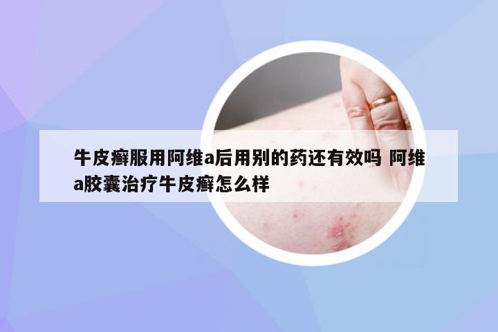 牛皮癣服用阿维a后用别的药还有效吗 阿维a胶囊治疗牛皮癣怎么样