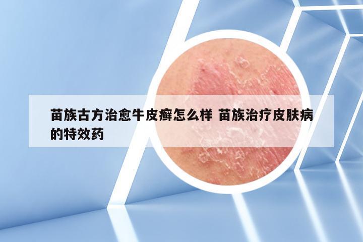 苗族古方治愈牛皮癣怎么样 苗族治疗皮肤病的特效药