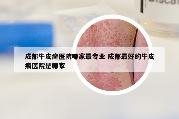 成都牛皮癣医院哪家最专业 成都最好的牛皮癣医院是哪家