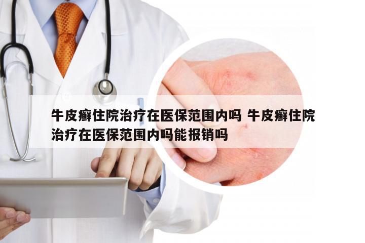 牛皮癣住院治疗在医保范围内吗 牛皮癣住院治疗在医保范围内吗能报销吗