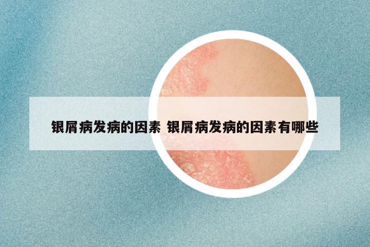银屑病发病的因素 银屑病发病的因素有哪些