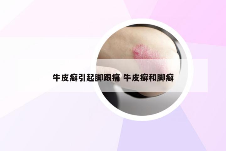 牛皮癣引起脚跟痛 牛皮癣和脚癣
