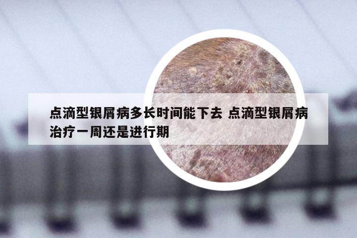 点滴型银屑病多长时间能下去 点滴型银屑病治疗一周还是进行期