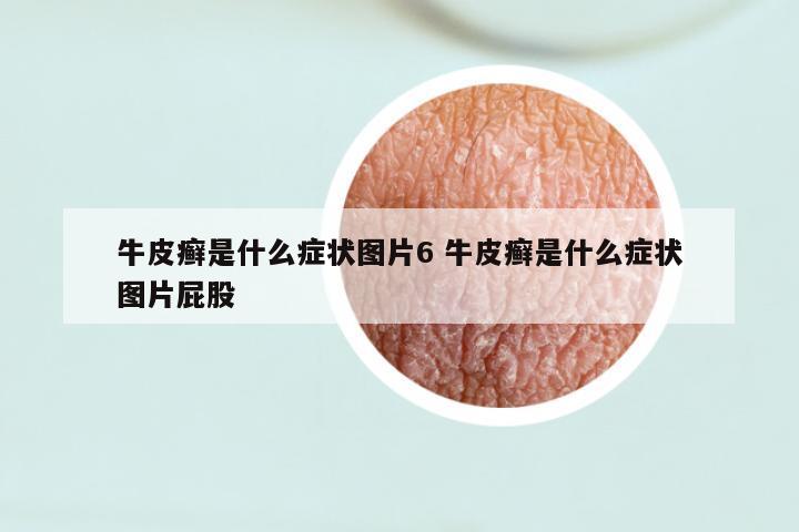 牛皮癣是什么症状图片6 牛皮癣是什么症状图片屁股
