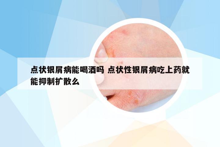 点状银屑病能喝酒吗 点状性银屑病吃上药就能抑制扩散么