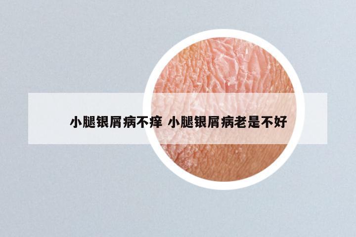 小腿银屑病不痒 小腿银屑病老是不好