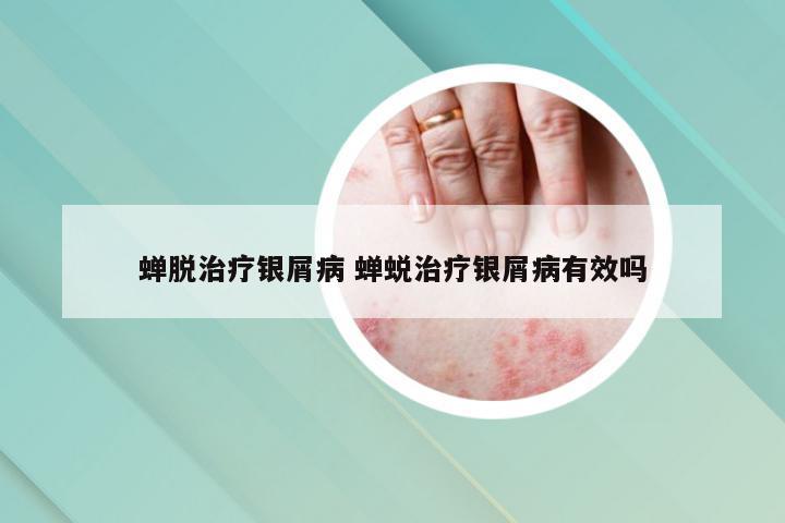 蝉脱治疗银屑病 蝉蜕治疗银屑病有效吗