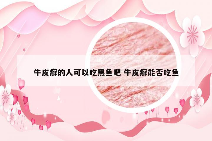 牛皮癣的人可以吃黑鱼吧 牛皮癣能否吃鱼