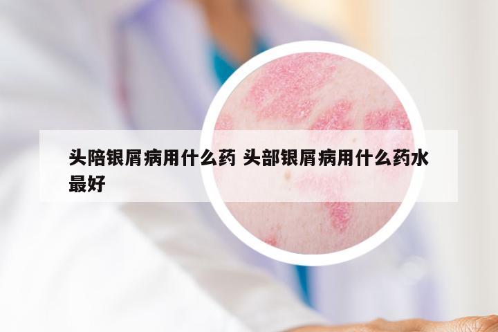 头陪银屑病用什么药 头部银屑病用什么药水最好