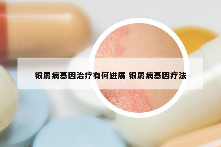银屑病基因治疗有何进展 银屑病基因疗法