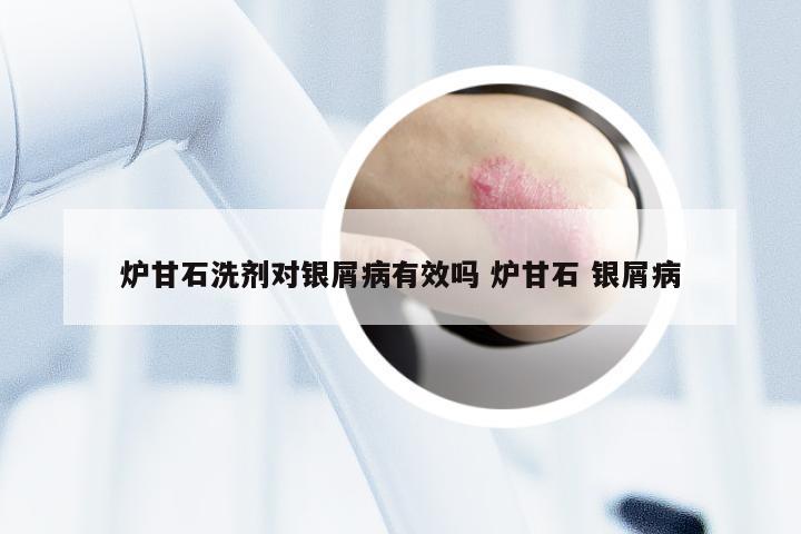 炉甘石洗剂对银屑病有效吗 炉甘石 银屑病