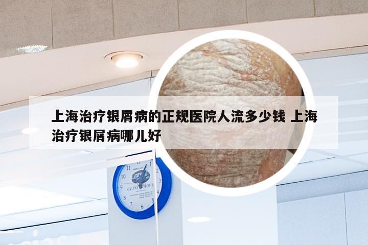 上海治疗银屑病的正规医院人流多少钱 上海治疗银屑病哪儿好
