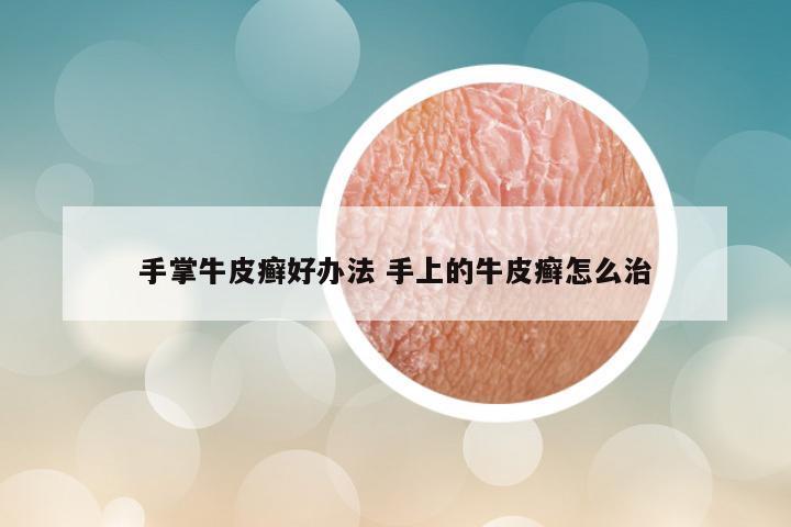 手掌牛皮癣好办法 手上的牛皮癣怎么治