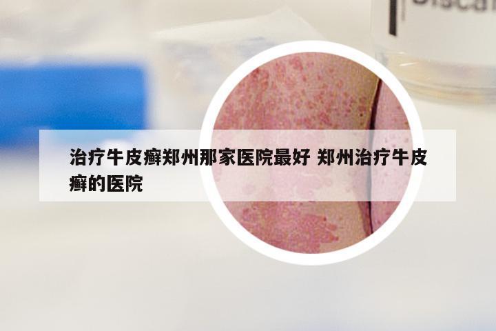 治疗牛皮癣郑州那家医院最好 郑州治疗牛皮癣的医院