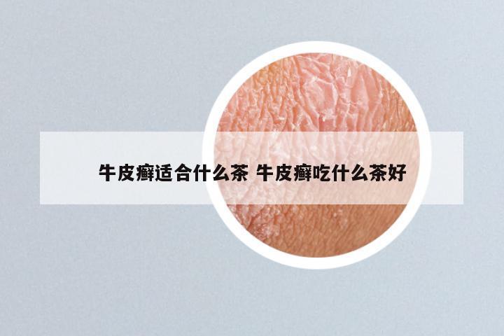 牛皮癣适合什么茶 牛皮癣吃什么茶好