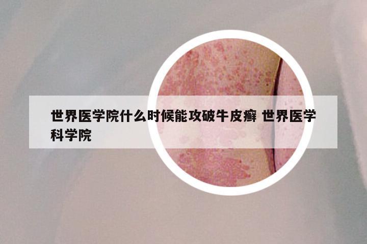 世界医学院什么时候能攻破牛皮癣 世界医学科学院