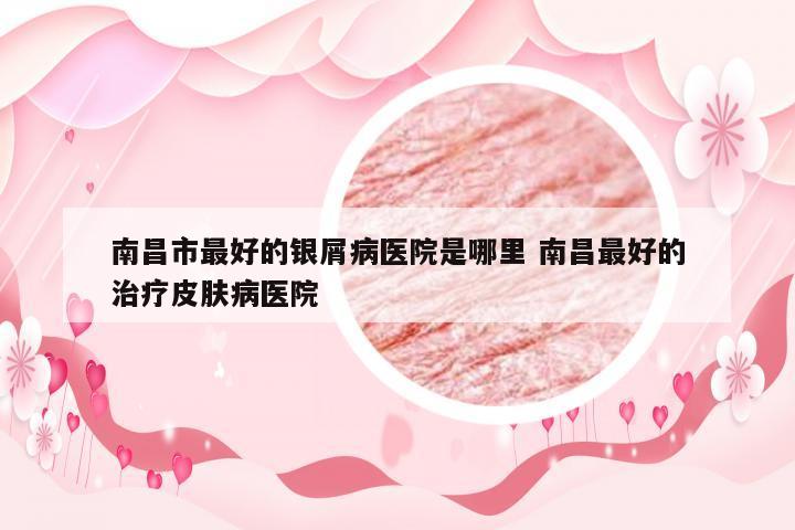 南昌市最好的银屑病医院是哪里 南昌最好的治疗皮肤病医院