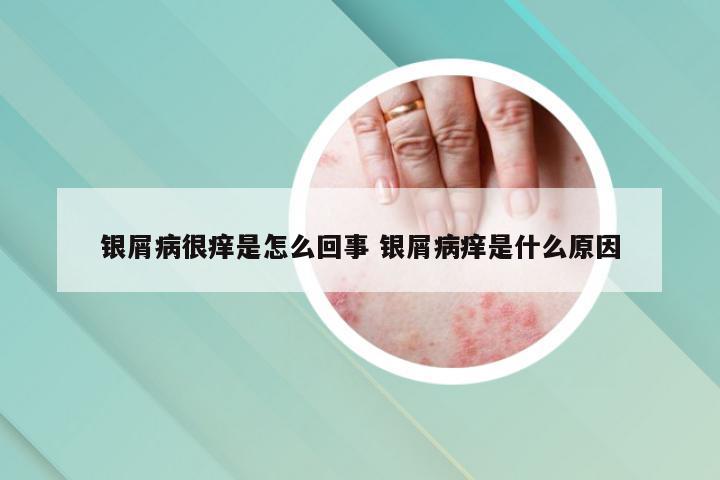 银屑病很痒是怎么回事 银屑病痒是什么原因