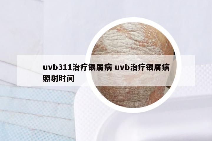 uvb311治疗银屑病 uvb治疗银屑病照射时间