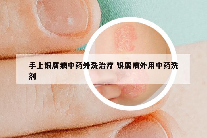 手上银屑病中药外洗治疗 银屑病外用中药洗剂