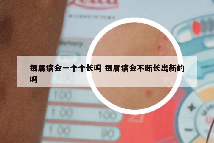 银屑病会一个个长吗 银屑病会不断长出新的吗