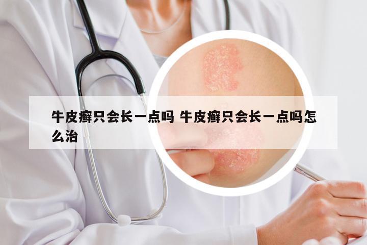 牛皮癣只会长一点吗 牛皮癣只会长一点吗怎么治
