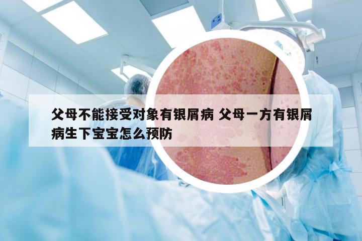 父母不能接受对象有银屑病 父母一方有银屑病生下宝宝怎么预防