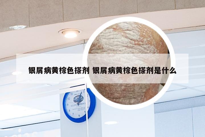 银屑病黄棕色搽剂 银屑病黄棕色搽剂是什么