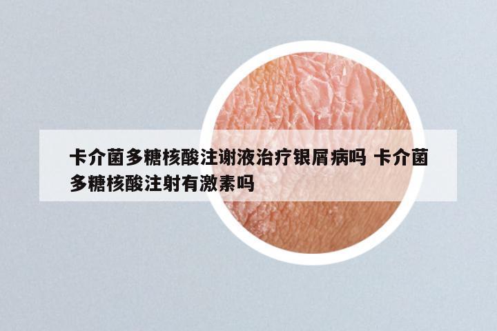 卡介菌多糖核酸注谢液治疗银屑病吗 卡介菌多糖核酸注射有激素吗