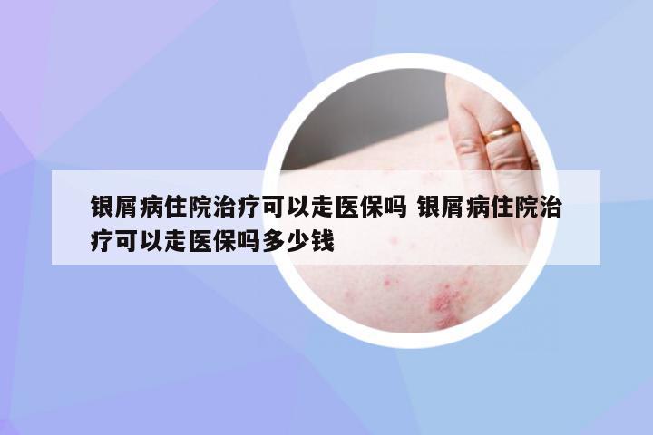 银屑病住院治疗可以走医保吗 银屑病住院治疗可以走医保吗多少钱