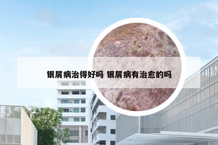 银屑病治得好吗 银屑病有治愈的吗