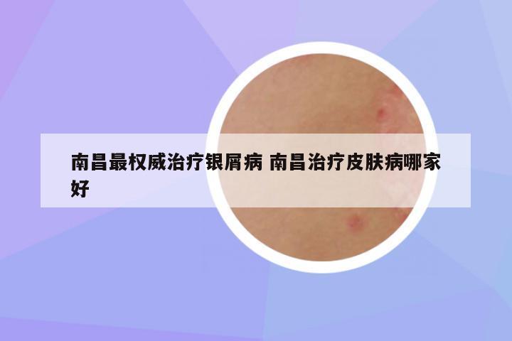 南昌最权威治疗银屑病 南昌治疗皮肤病哪家好