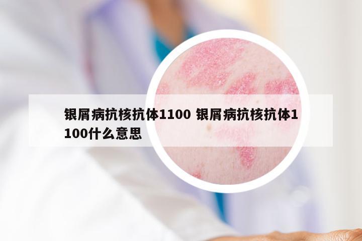 银屑病抗核抗体1100 银屑病抗核抗体1100什么意思