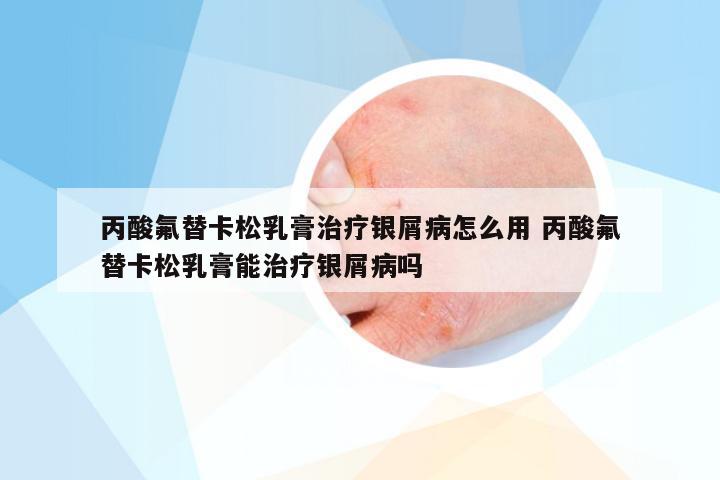 丙酸氟替卡松乳膏治疗银屑病怎么用 丙酸氟替卡松乳膏能治疗银屑病吗