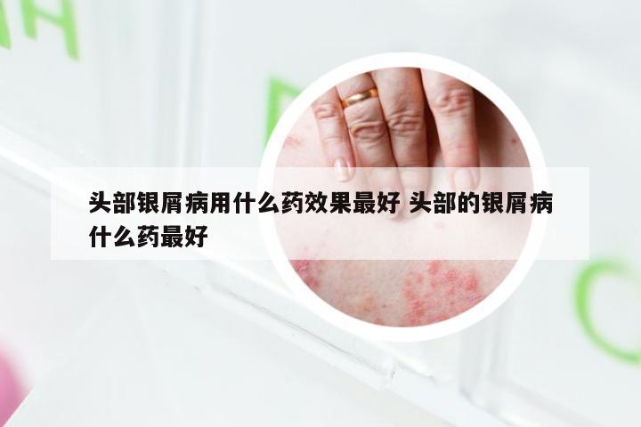 头部银屑病用什么药效果最好 头部的银屑病什么药最好