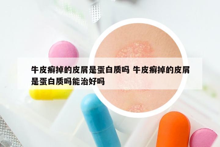 牛皮癣掉的皮屑是蛋白质吗 牛皮癣掉的皮屑是蛋白质吗能治好吗