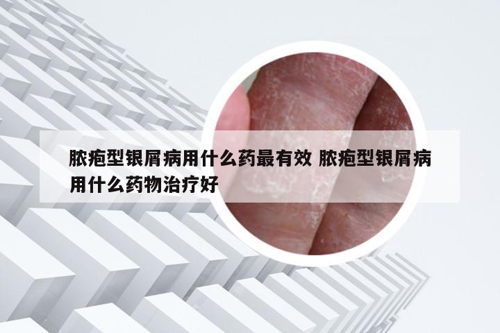 脓疱型银屑病用什么药最有效 脓疱型银屑病用什么药物治疗好