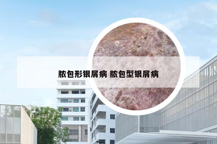 脓包形银屑病 脓包型银屑病