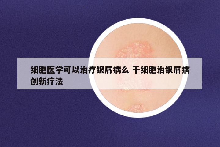 细胞医学可以治疗银屑病么 干细胞治银屑病创新疗法