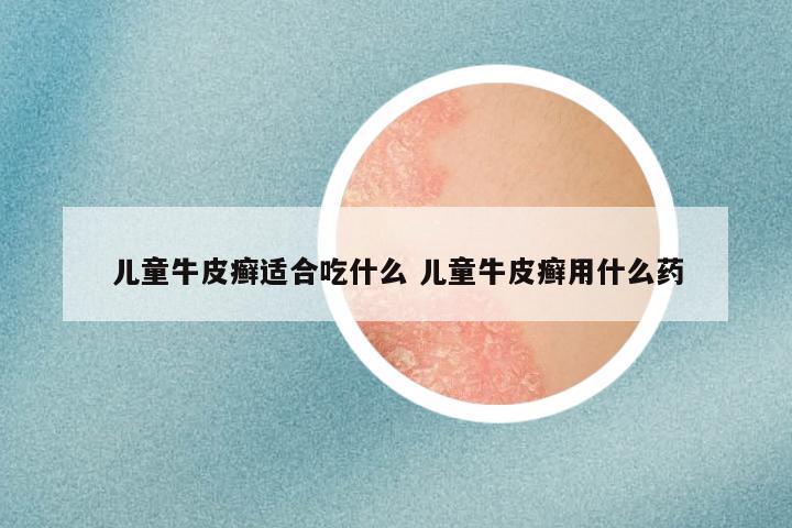 儿童牛皮癣适合吃什么 儿童牛皮癣用什么药