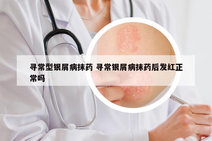 寻常型银屑病抹药 寻常银屑病抹药后发红正常吗