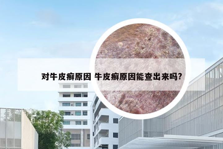 对牛皮癣原因 牛皮癣原因能查出来吗?