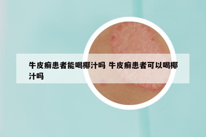 牛皮癣患者能喝椰汁吗 牛皮癣患者可以喝椰汁吗