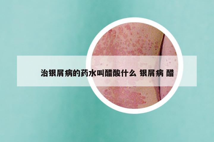 治银屑病的药水叫醋酸什么 银屑病 醋